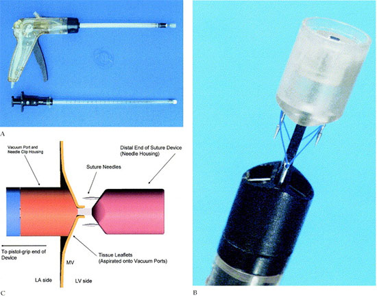 The experimental device. (A) The suture device on the top, the knot pusher on the bottom, and the monofilament sutures with straight needles in the middle. The device passes into the cardiac chambers through a port access cannula in the left atrium (pictured in Fig 2). (B) Close-up view of the distal end of the suture device showing the two suction parts and the four needles partially deployed. (C) Schematic depiction of the method of firing of the stitches through the mitral valve (MV) leaflets. (LA = left atrium; LV = left ventricle.)